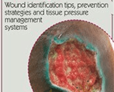 Is it a pressure ulcer or moisture-associated skin damage? Wound identification tips