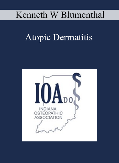 Kenneth W Blumenthal - Atopic Dermatitis