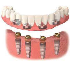 Fast Track Full - Arch Dentistry Implant Overdentures